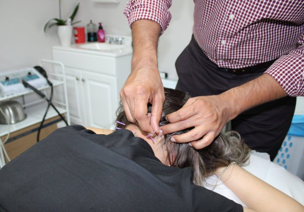 dry-needling