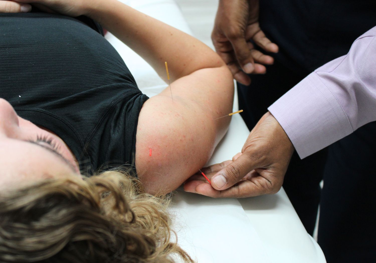 dry needling